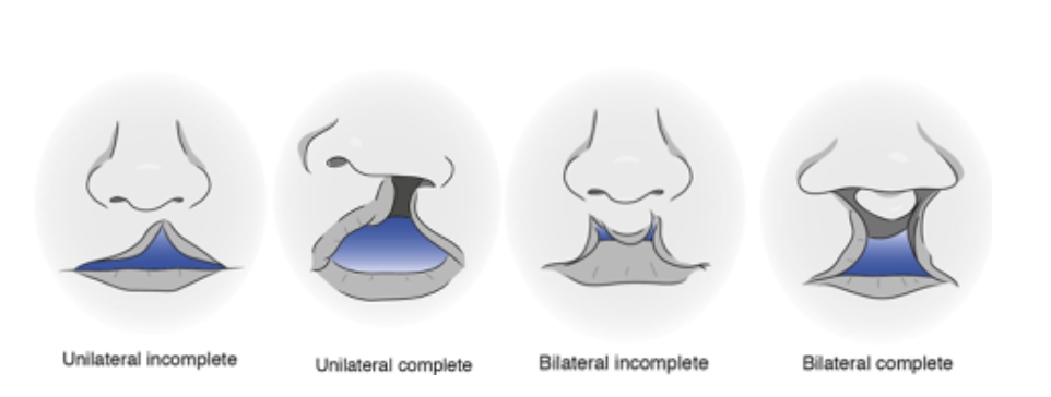 CLEFT PALATE IN CHILDREN